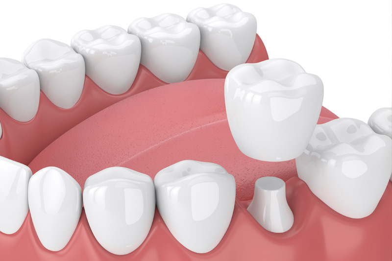 Dental Crowns in Woonsocket