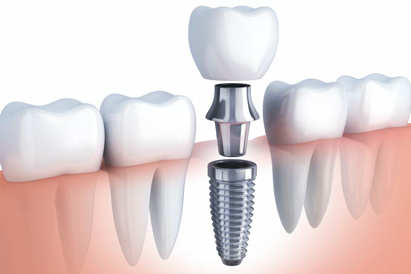 Implants Dentist in Woonsocket