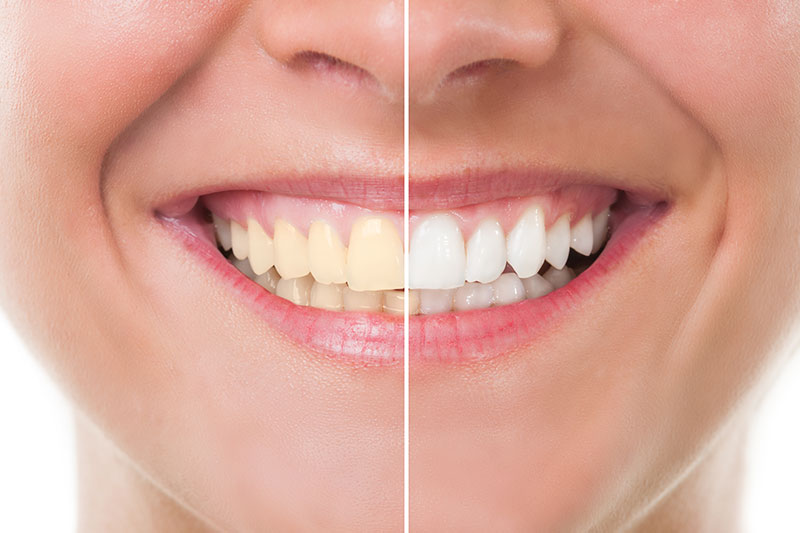 Teeth Whitening in Woonsocket