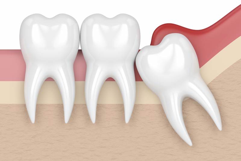 Wisdom Tooth Removal in Woonsocket